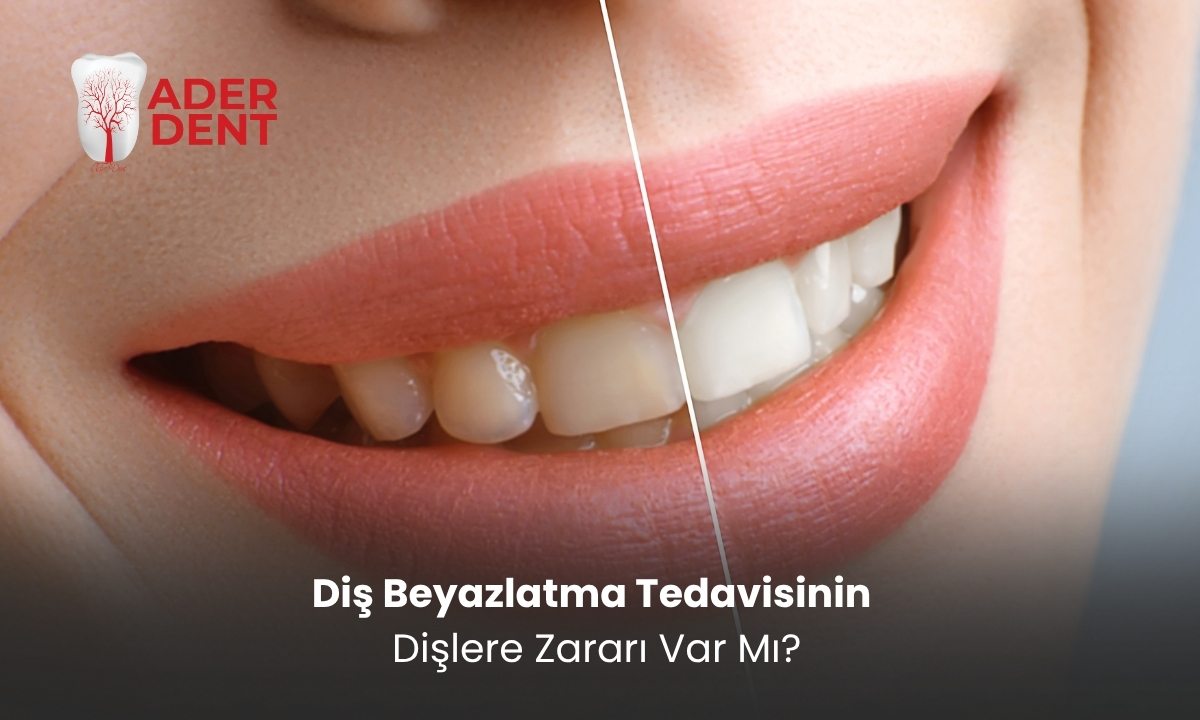 Diş Beyazlatma Tedavisinin Dişlere Zararı Var Mı?