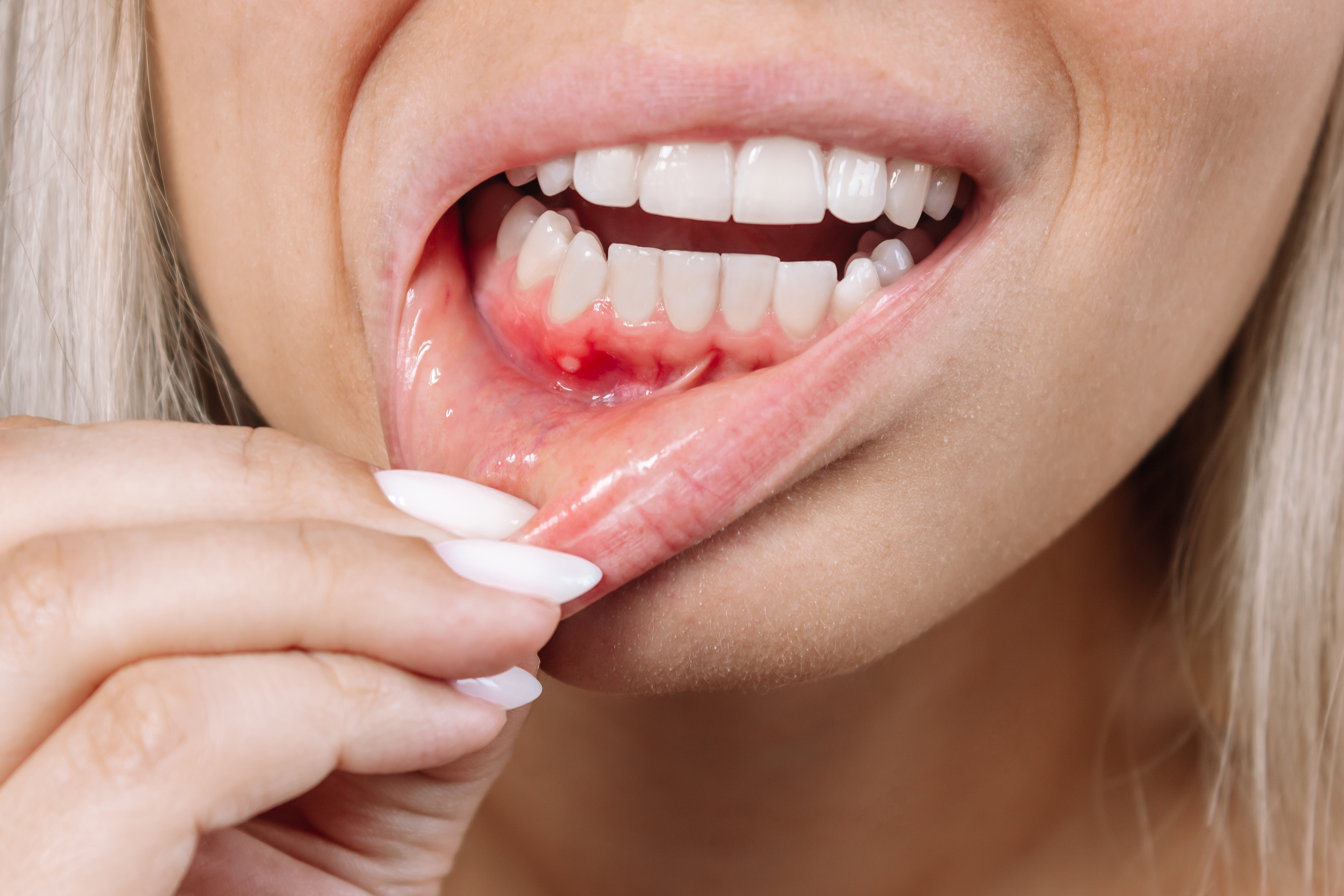 What Causes Receding Gums (Periodontitis)? What Is Good for Receding Gums?