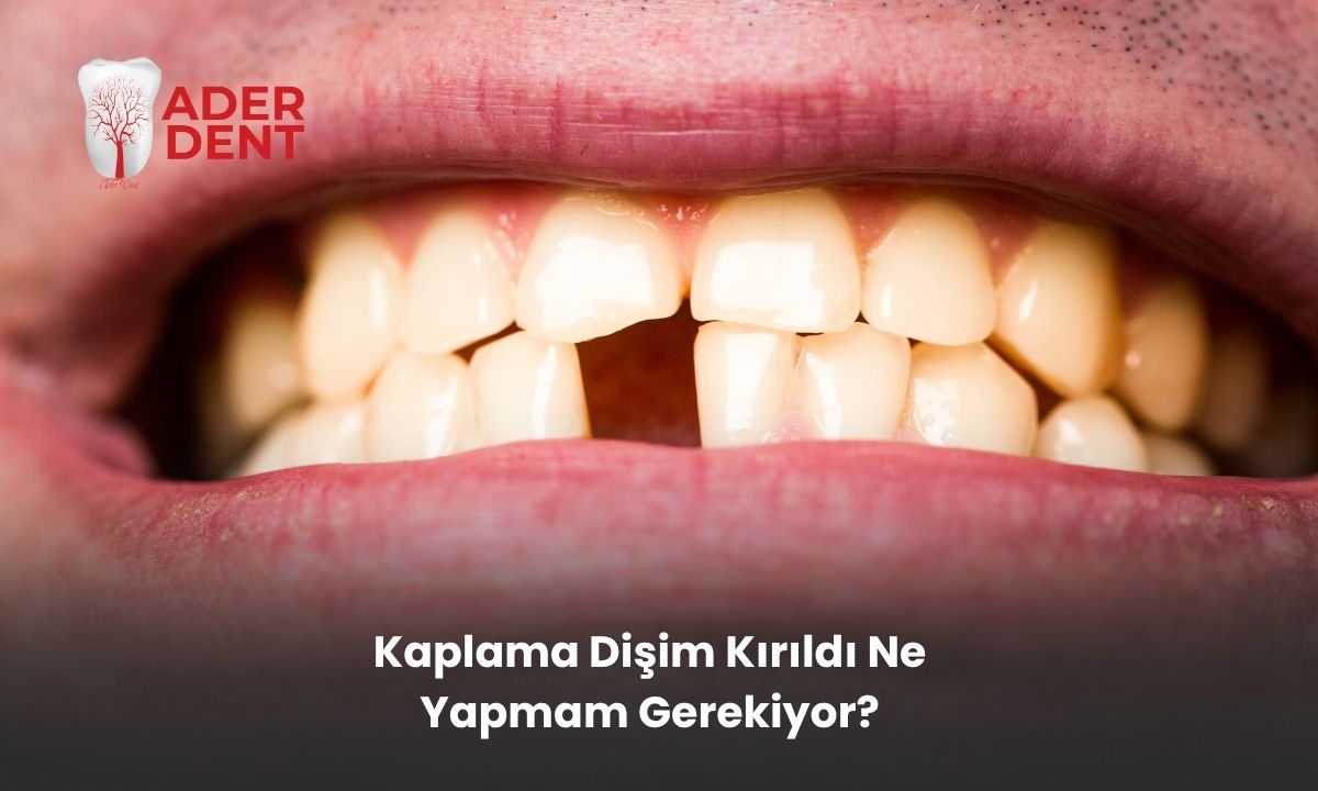 Kaplama Dişim Kırıldı Ne Yapmam Gerekiyor?