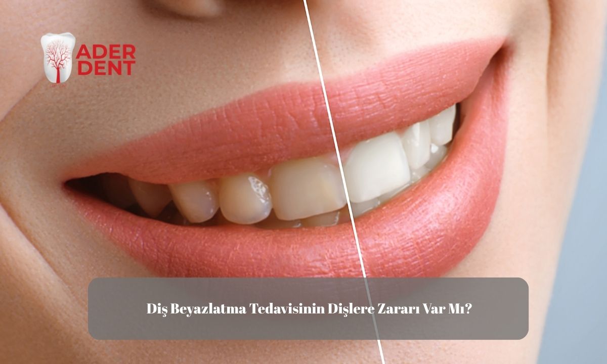 Diş Beyazlatma Tedavisinin Dişlere Zararı Var Mı?