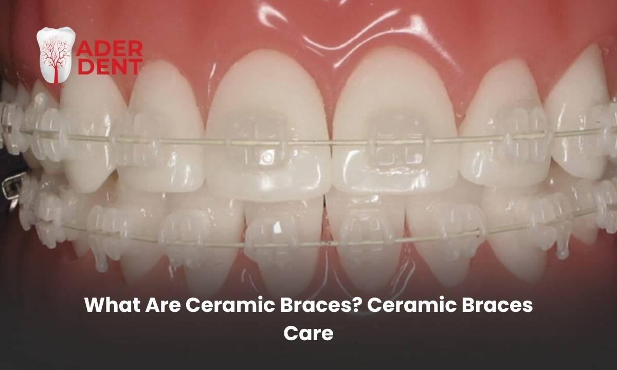 What Are Ceramic Braces? Ceramic Braces Care