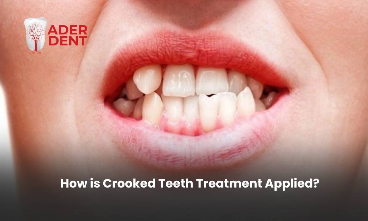 How is Crooked Teeth Treatment Applied?
