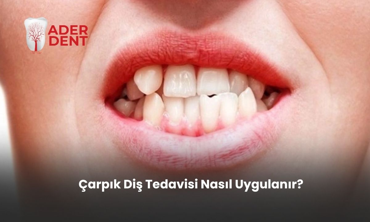 Çarpık Diş Tedavisi Nasıl Uygulanır?