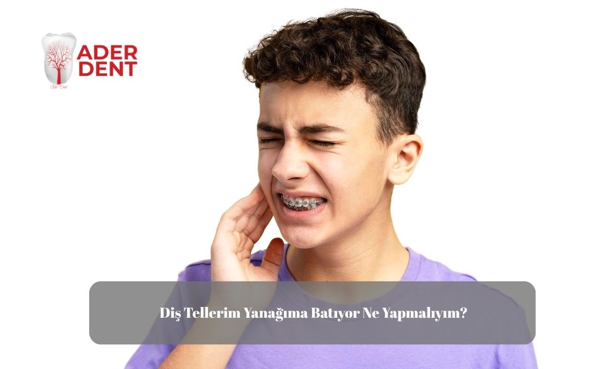Diş Tellerim Yanağıma Batıyor, Ne Yapabilirim?