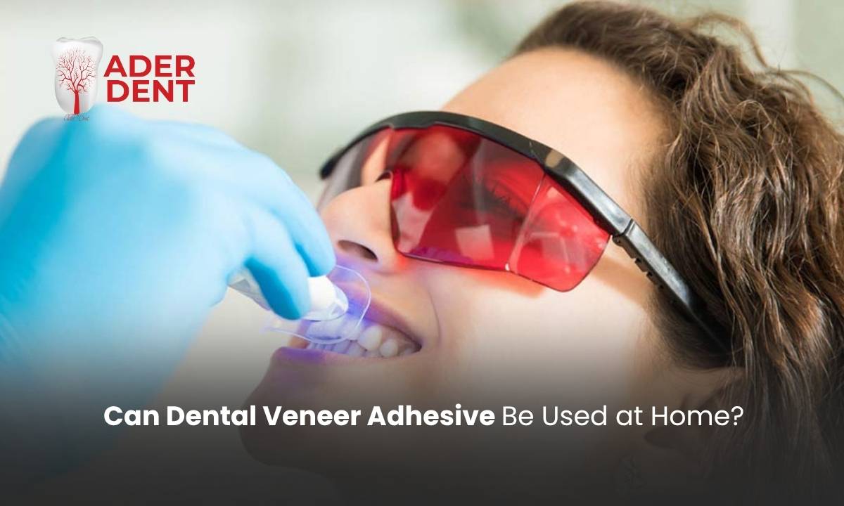 Can Dental Veneer Adhesive Be Used at Home?