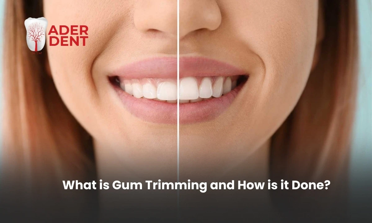  What is Gum Trimming and How is it Done?