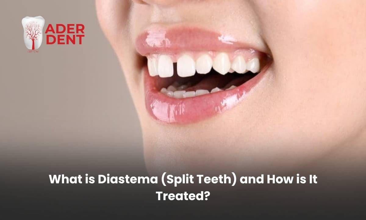 What is Diastema (Split Teeth) and How is It Treated?