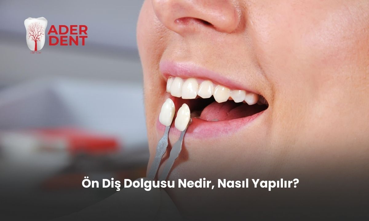 Ön Diş Dolgusu Nedir, Nasıl Yapılır?