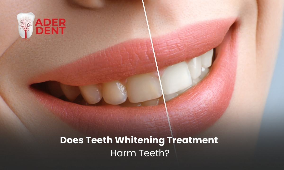 Does Teeth Whitening Treatment Harm Teeth?