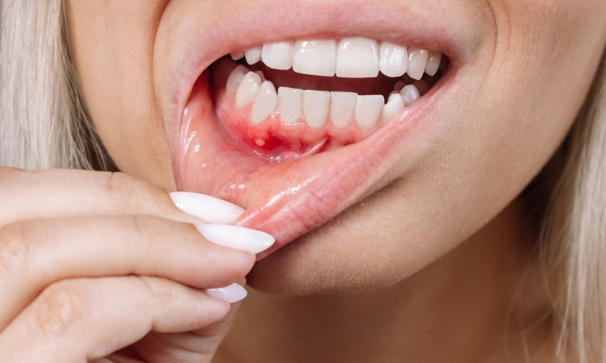 Diş Eti Çekilmesi (Periodontitis) Neden Olur? Diş Eti Çekilmesine Ne İyi Gelir?