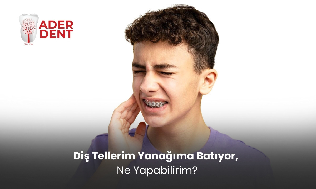 Diş Tellerim Yanağıma Batıyor, Ne Yapabilirim?