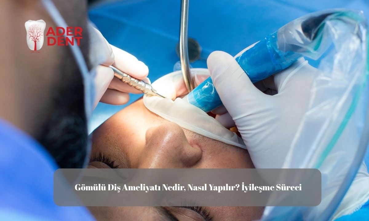 Gömülü Diş Ameliyatı Nedir, Nasıl Yapılır? İyileşme Süreci