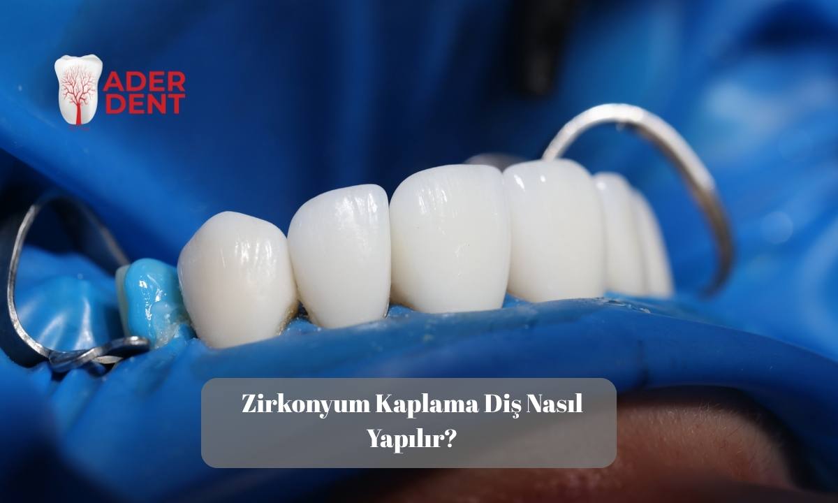 Zirkonyum Kaplama Diş Nasıl Yapılır?